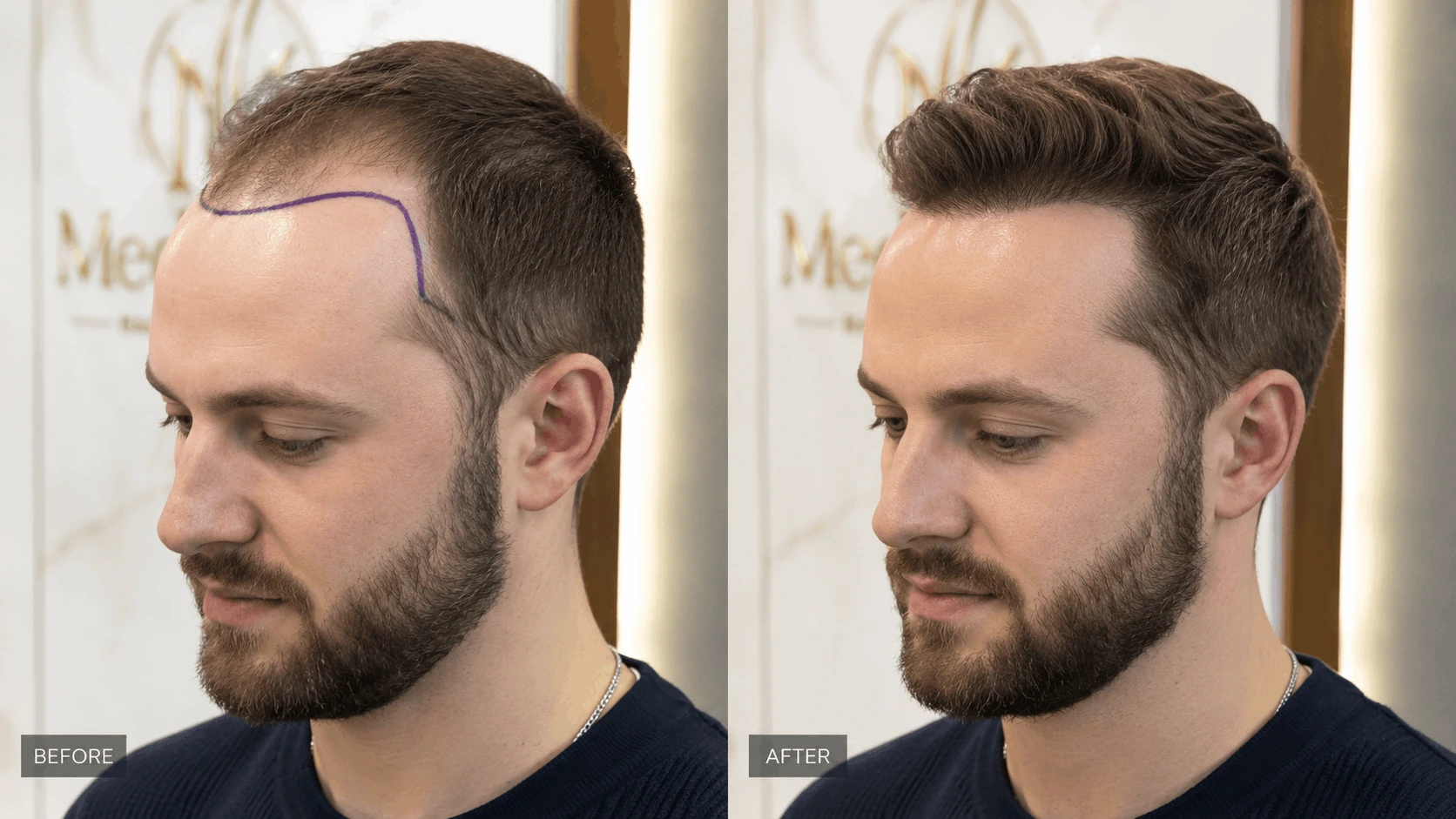 Dhi haartransplantation vorher nachher. DHI Verfahren zur Haartransplantation in der MediCenna Hair Clinic Hamburg
